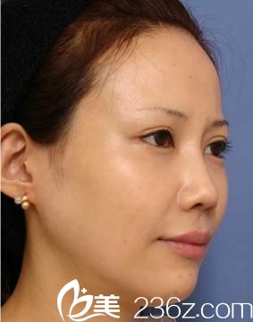 福田慶三全切雙眼皮術(shù)后側(cè)面展示 福田慶三全切雙眼皮術(shù)后側(cè)面展示