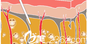 面部吸脂示意圖