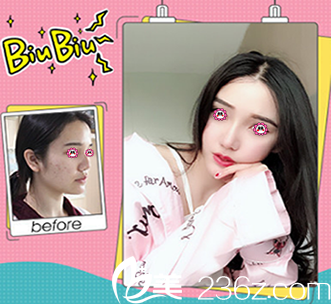 湛美朱院長(zhǎng)隆鼻前后對(duì)比圖