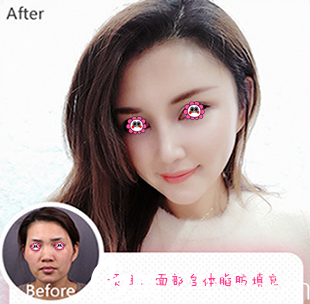 我在湛美整形醫(yī)院做面部自體脂肪填充后的樣子