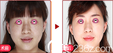 廣東湛美祛斑變化圖