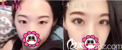 北京煤醫(yī)整形梁偉中眼綜合