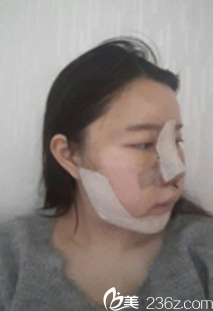 韓國新帝瑞娜面部輪廓+鼻修復手術術后第2天