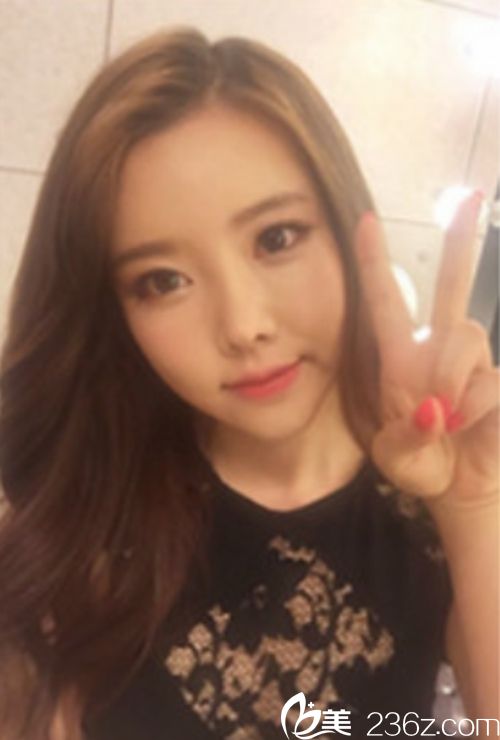 韓國新帝瑞娜面部輪廓+鼻修復手術術后第120天