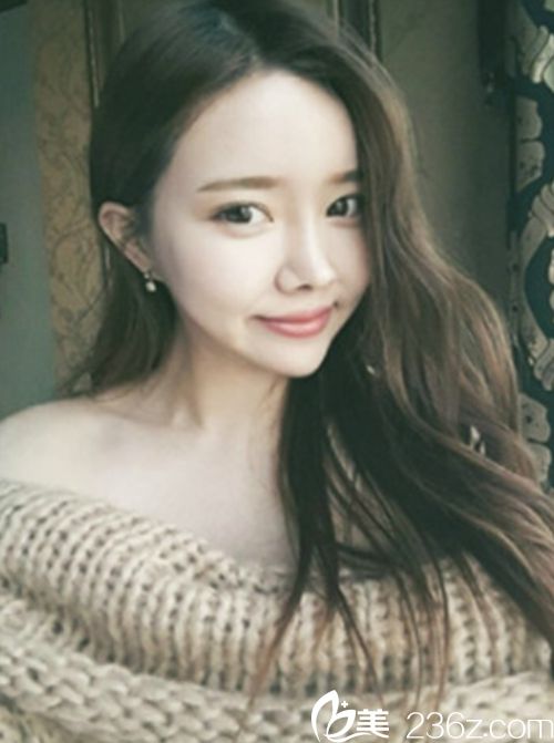 韓國新帝瑞娜面部輪廓+鼻修復手術術后第330天