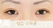 池本繁醫(yī)生的高超雙眼皮修復(fù) 池本繁醫(yī)生的高超雙眼皮修復(fù)