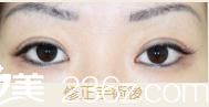 池本形成外科.美容外科池本繁醫(yī)生的高超雙眼皮修復前后對比，讓我目若秋波