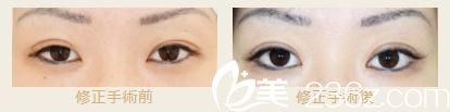 池本繁醫(yī)生的高超雙眼皮修復(fù)對(duì)比照片 池本繁醫(yī)生的高超雙眼皮修復(fù)對(duì)比照片