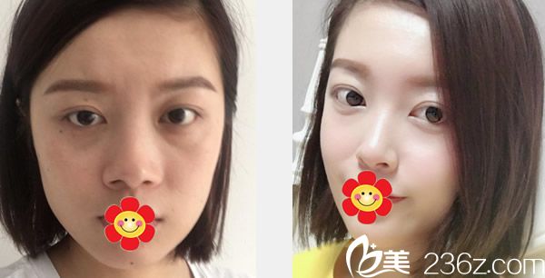 五洲王煥醫(yī)生玻尿酸豐面頰+自體軟骨綜合隆鼻前后效果對比圖 五洲王煥醫(yī)生玻尿酸豐面頰+自體軟骨綜合隆鼻前后效果對比圖