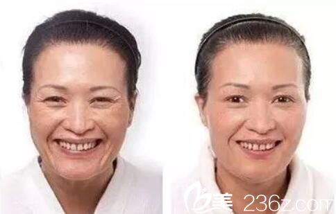 洛陽華美瘦臉除皺注射除皺