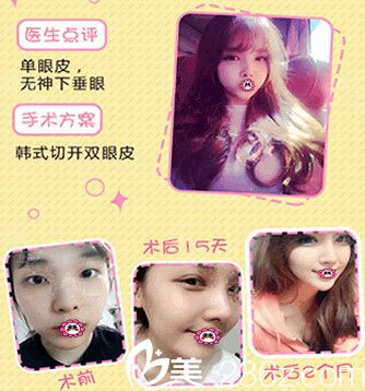 南通維多利亞做雙眼皮變化圖
