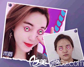 我在南通維多利亞做完線雕V臉后變得更美了