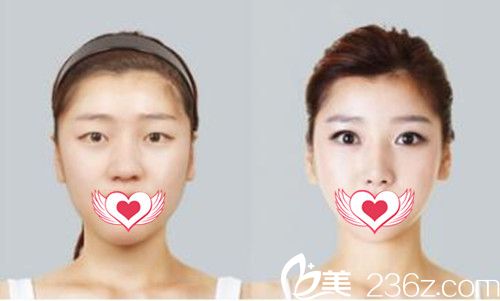 佛山華美割雙眼皮案例效果對比