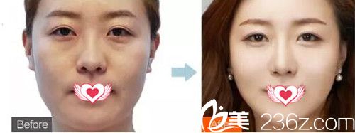 佛山華美整形除皺案例效果