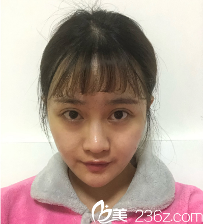 深圳非凡易培金全切雙眼皮7天拆線圖片