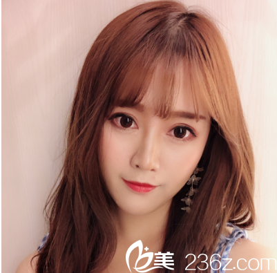 深圳非凡易培金做的雙眼皮案例15天照片