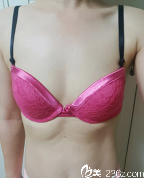 韓國麥恩醫(yī)院motiva假體隆胸手術(shù)術(shù)前 韓國麥恩醫(yī)院motiva假體隆胸手術(shù)術(shù)前