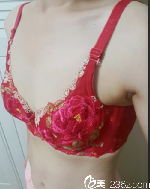 韓國麥恩醫(yī)院motiva假體隆胸手術(shù)術(shù)前 韓國麥恩醫(yī)院motiva假體隆胸手術(shù)術(shù)前