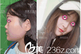 北京潤美玉之光張紅芳鼻子案例