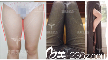 北京潤美玉之光張紅芳醫(yī)生腿部吸脂案例