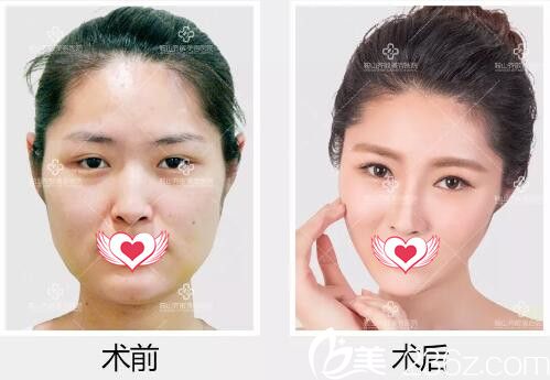 鄭裕錫面部五官綜合打造真人效果對比