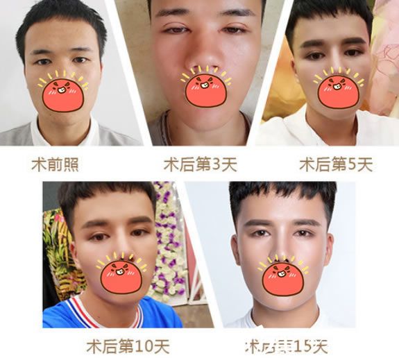 無錫施爾美李雄艷雙眼皮案例 無錫施爾美李雄艷雙眼皮案例