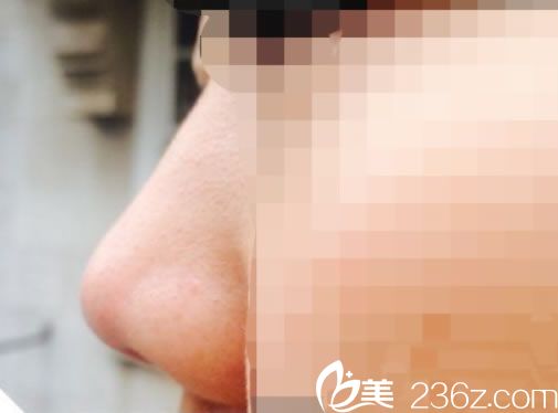 無錫施爾美李雄艷注射玻尿酸隆鼻案例 1ml玻尿酸成功擺脫塌鼻梁