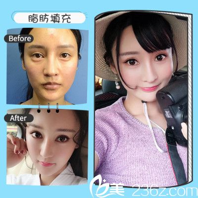 深圳非凡王永祥做的自體脂肪面部填充案例 深圳非凡王永祥做的自體脂肪面部填充案例