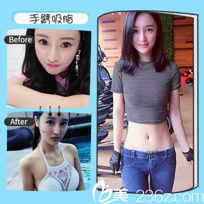 深圳非凡黃純醫(yī)生吸脂真人案 深圳非凡黃純醫(yī)生吸脂真人案