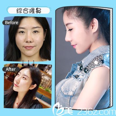 深圳非凡梅夠明做的隆鼻案例 深圳非凡梅夠明做的隆鼻案例