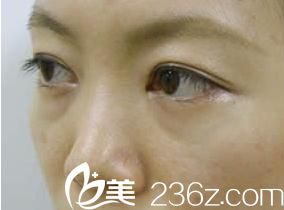祛眼袋手術(shù)前側(cè)面展示 祛眼袋手術(shù)前側(cè)面展示