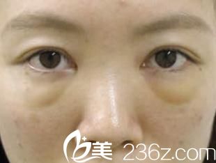 手術(shù)三天后 手術(shù)三天后