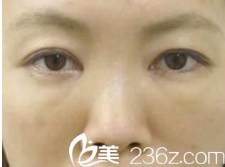 手術(shù)一周后 手術(shù)一周后