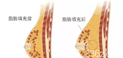 自體脂肪填充前后對比圖