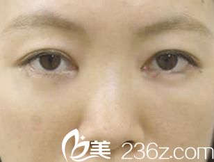 手術(shù)兩周后 手術(shù)兩周后