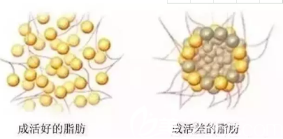 自體脂肪成活率