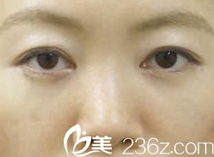 手術(shù)一個(gè)月 手術(shù)一個(gè)月