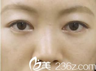 看眼袋終結(jié)者水谷和則醫(yī)生為我祛眼袋的術(shù)后效果