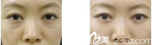 去眼袋手術(shù)前后對(duì)比 去眼袋手術(shù)前后對(duì)比
