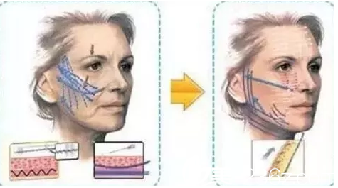 長(zhǎng)春瑞麗線雕提升貴不貴？看一下瑞麗2018年年優(yōu)惠價(jià)格線雕12580元起