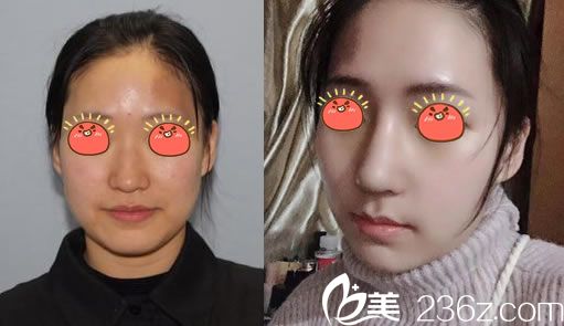 寧波薇琳張潮肋軟骨鼻綜合案例 寧波薇琳張潮肋軟骨鼻綜合案例