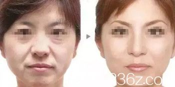 邯鄲維多利亞雙12優(yōu)惠活動火熱開啟 注射愛芙萊玻尿酸和除皺針都只要980元