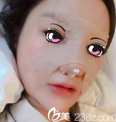 剛做完肋軟骨鼻綜合隆鼻照片