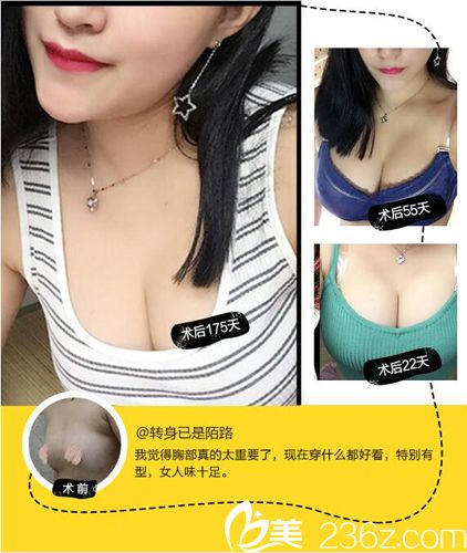 付榮峰自體脂肪豐胸案例