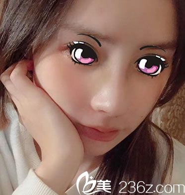 肋軟骨鼻綜合手術(shù)7天恢復(fù)照