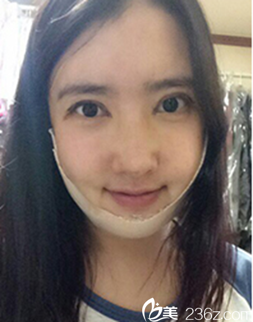 韓國新帝瑞娜醫(yī)院做眼部+鼻部+脂肪填充+v-line術后一周后