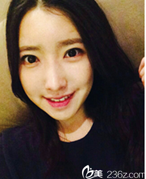 韓國新帝瑞娜醫(yī)院做眼部+鼻部+脂肪填充+v-line術后1個月后