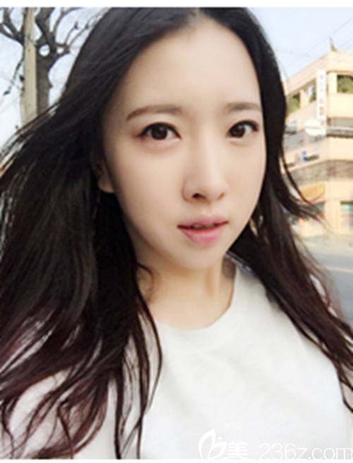 韓國新帝瑞娜醫(yī)院做眼部+鼻部+脂肪填充+v-line術后6個月后