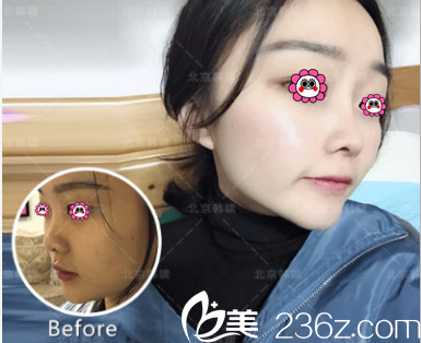 北京韓嘯耳軟骨復(fù)合隆鼻多少錢?韓嘯整形隆鼻價(jià)格案例搶先看