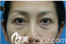 治療前眼袋和松弛明顯 治療前眼袋和松弛明顯